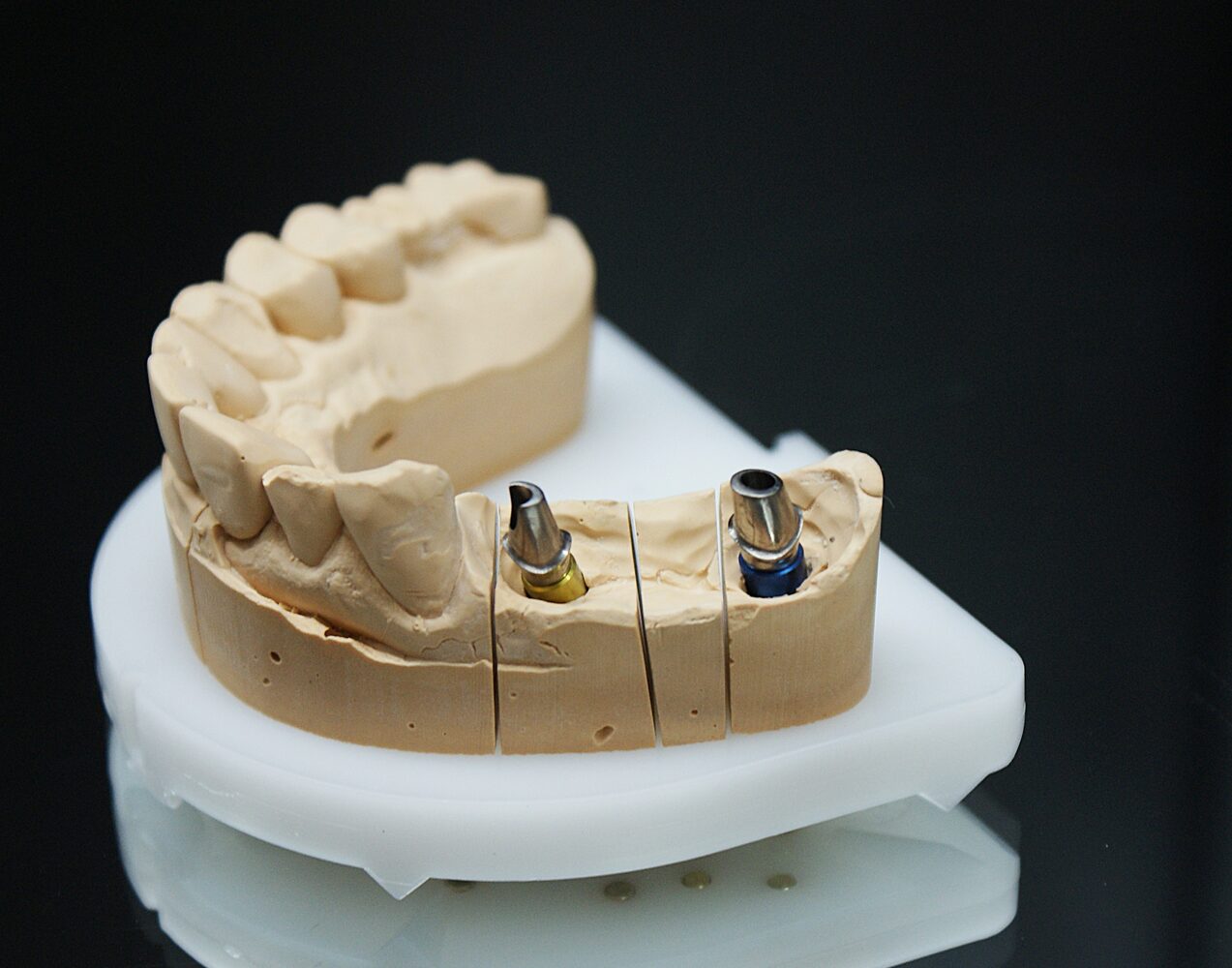 Implantatmodell zur Versorgungsplanung
